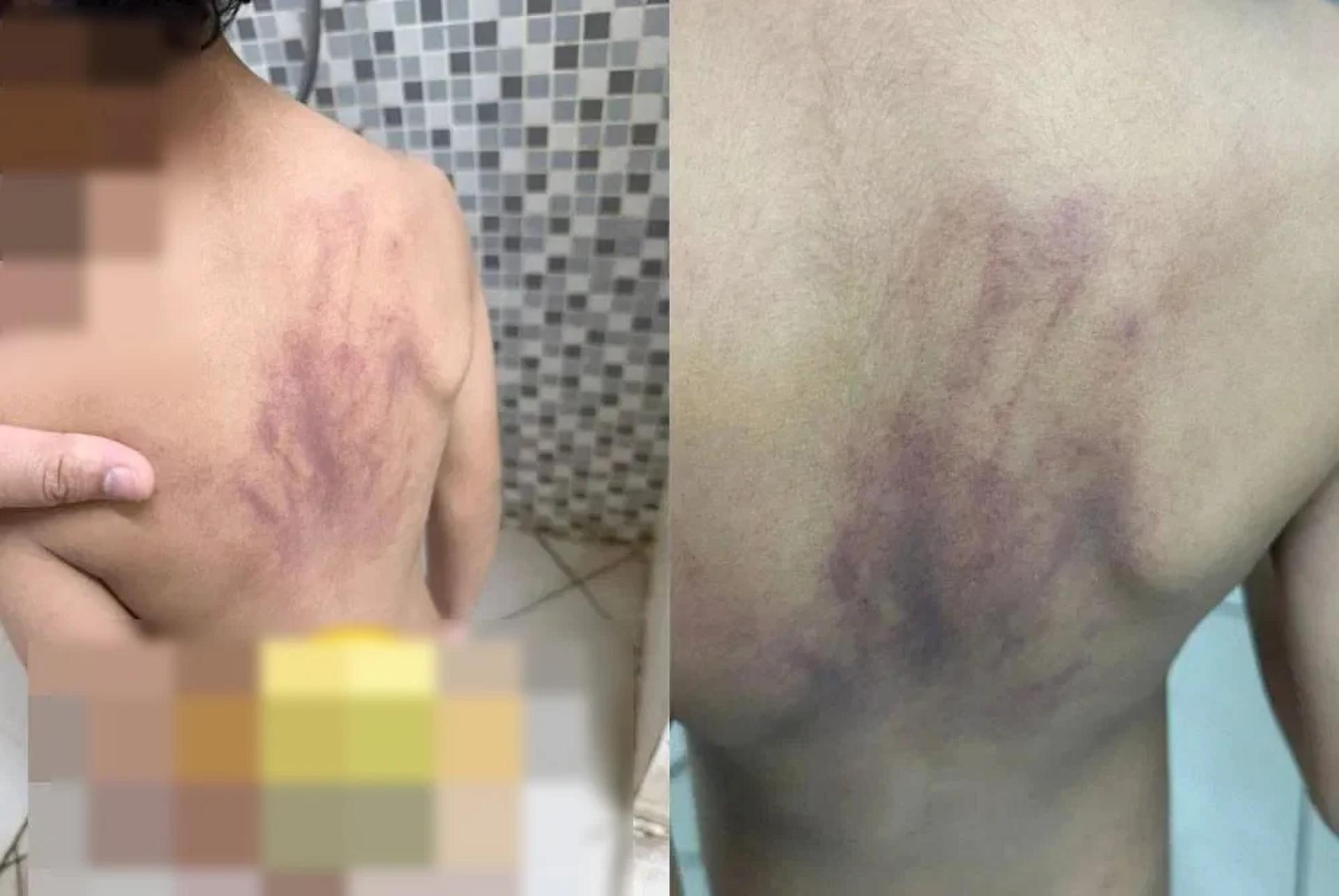 一名自闭症儿童疑在托儿所遭受虐待，其父母发现他的背部有大片瘀伤，在经医生检查后，确认伤势非意外跌倒所致。