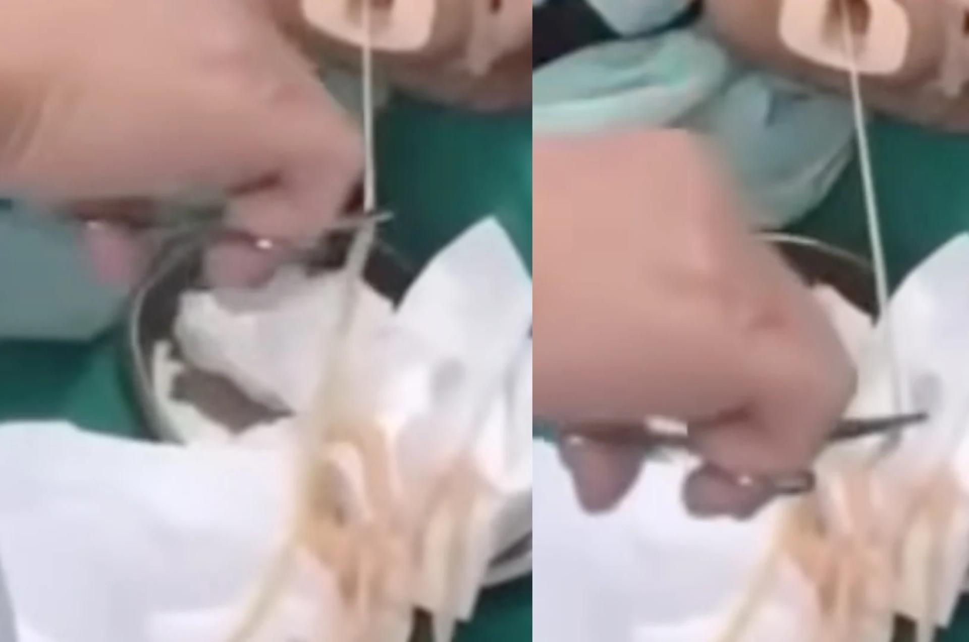 医生透过软管从女病人的胃中拉出长长的绦虫（Tapeworm），拉了很久才把完整的寄生虫拉出来。