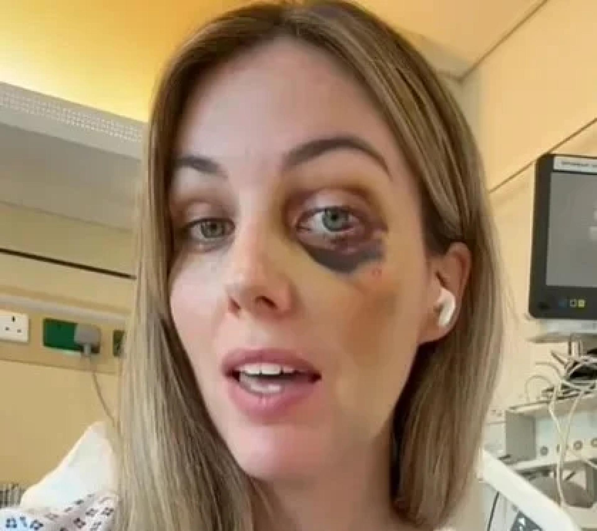 艾美丽突然倒地导致左臂严重淤青，眼部也出现黑眼圈，昏迷时间至少长达5分钟。