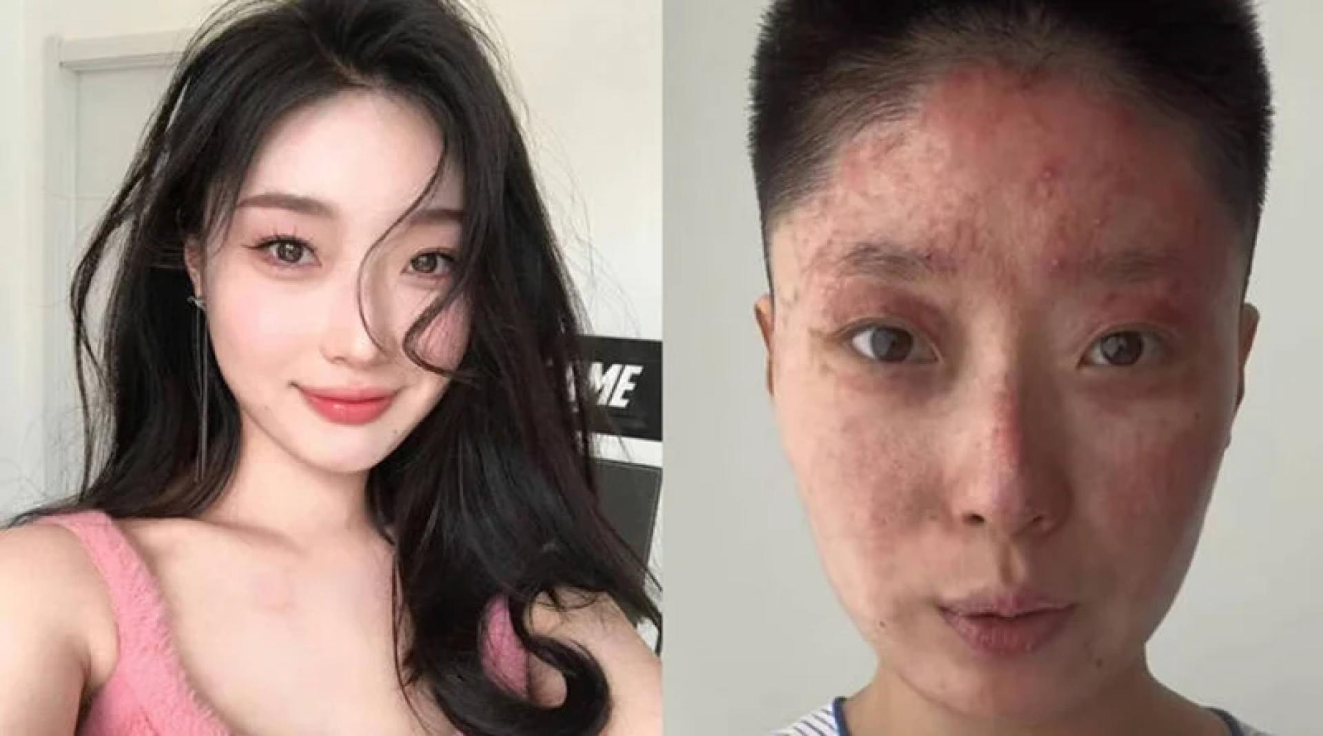 中国美妆网红佟诗瑶家中发生气爆，脸部二度烧伤，险些毁容。