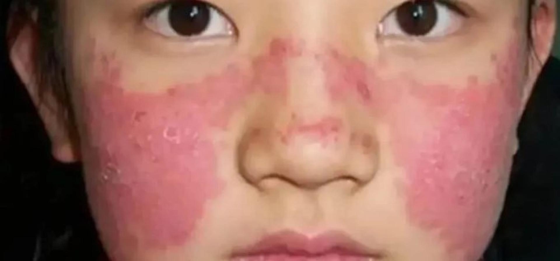 感染苹果病后脸和手臂等部位会出红疹。