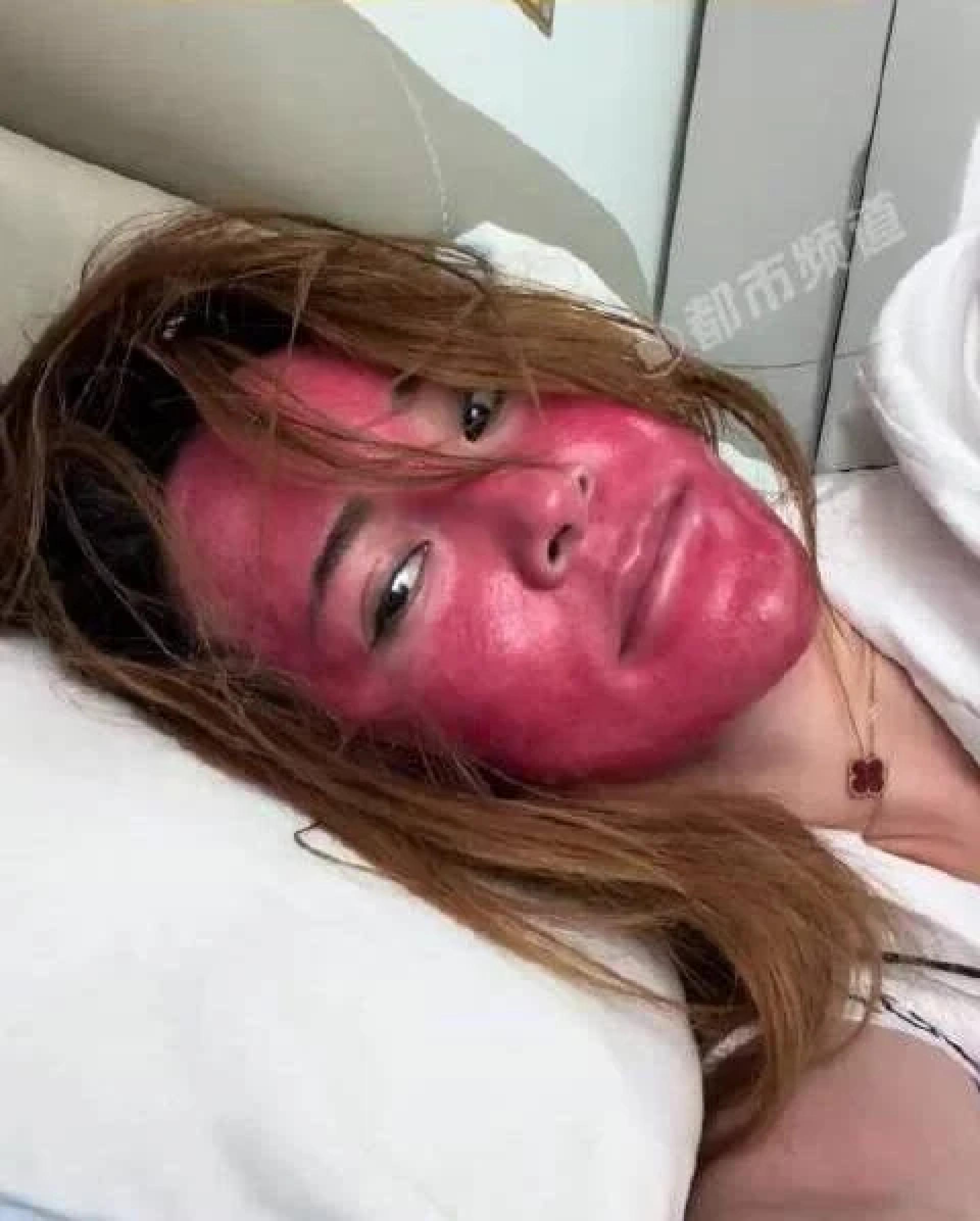 女子自称22年几乎不卸妆，最终脸部红肿如“关公”，皮肤“像硬壳一样”。（图：微博）