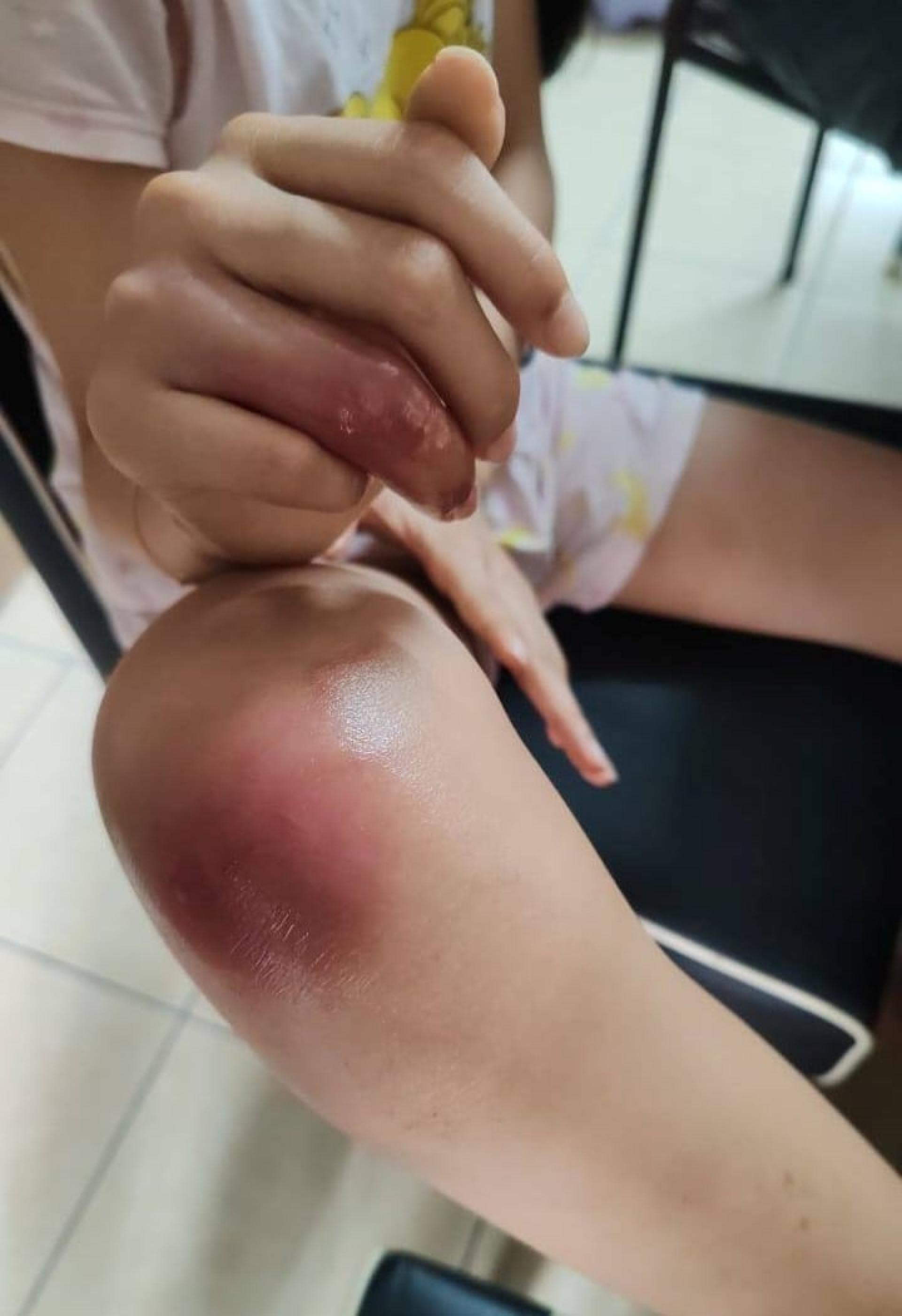 家属在社交媒体分享，孩子被扣针割伤后，导致细菌感染，险些手指不保的经历。