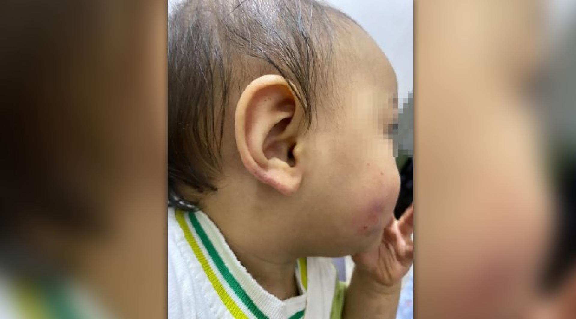 男婴右面颊和右耳出现红肿伤势。
