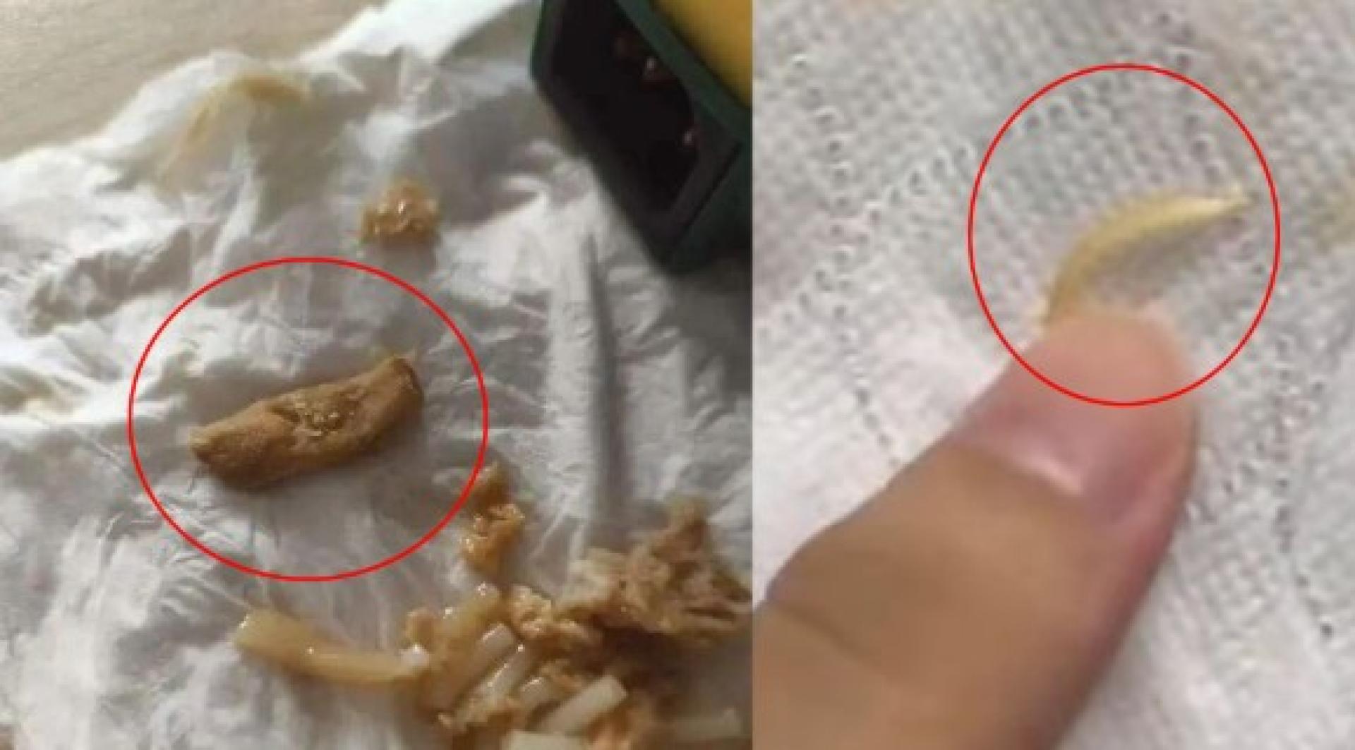 多名消费者投诉在中国知名螺蛳粉品牌“臭宝”产品中吃出疑似脚趾甲、烟头等令人作呕的异物。