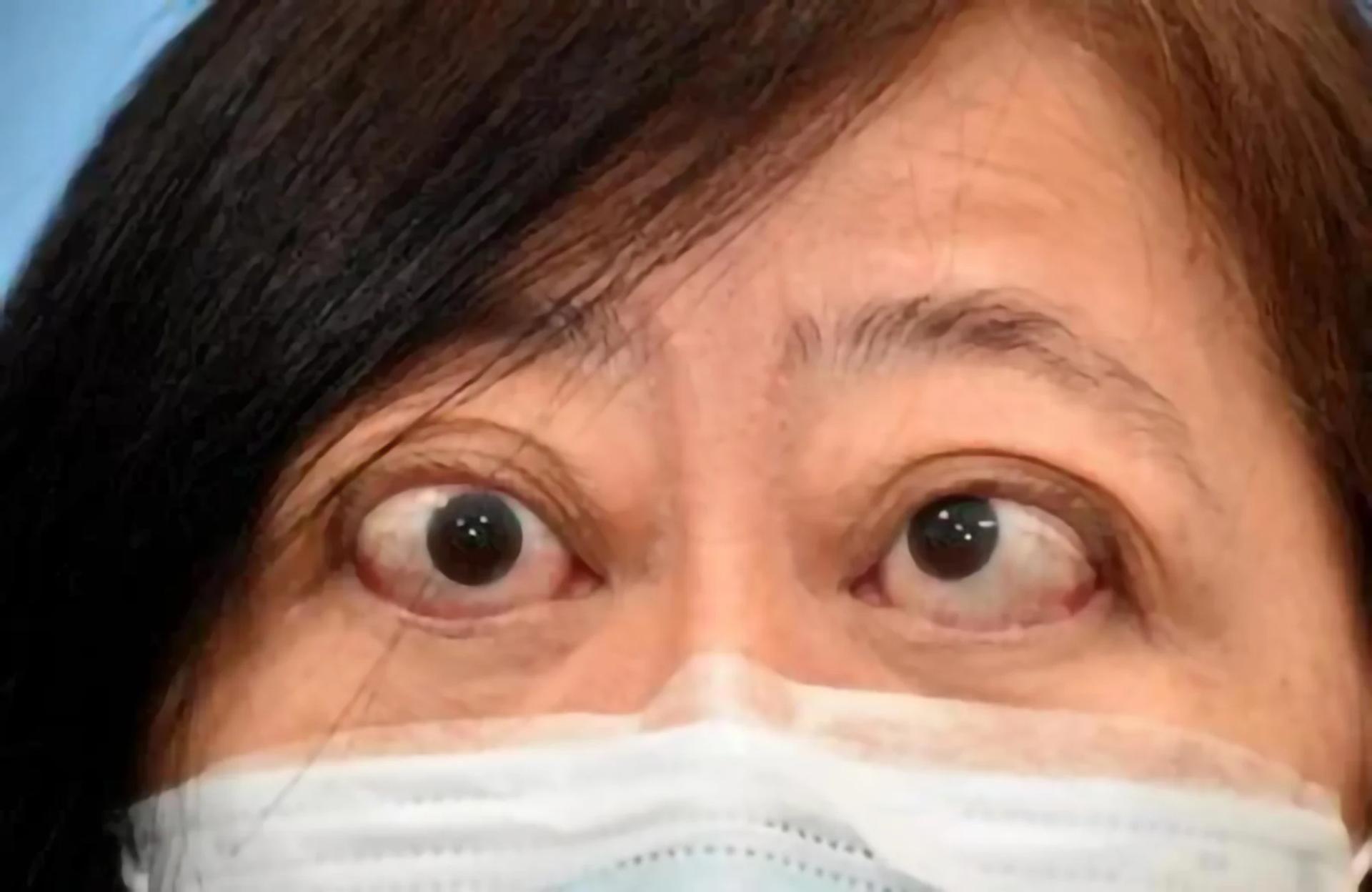 吴女士曾患上甲状腺眼病，导致眼睛肿胀斜视。（新加坡国立大学医学组织提供）