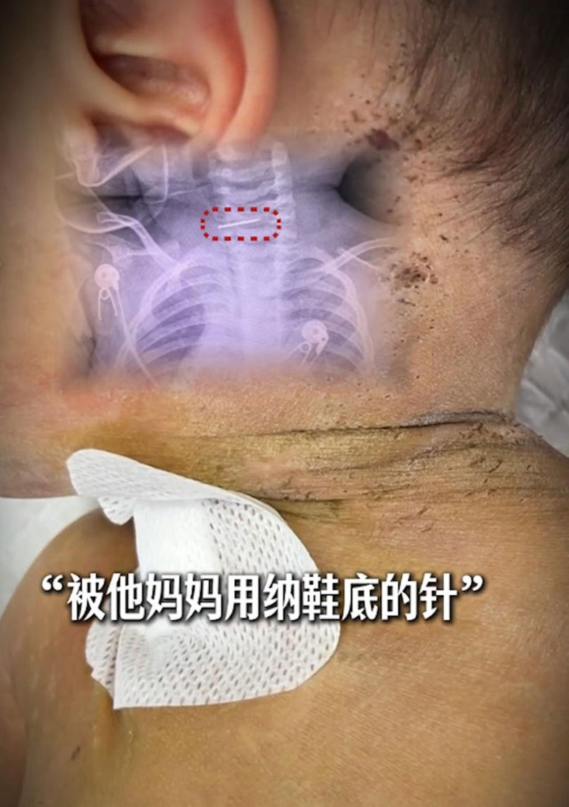 医生称，接诊10个月大男婴全身被扎数百针孔，断针留在颈椎里。
