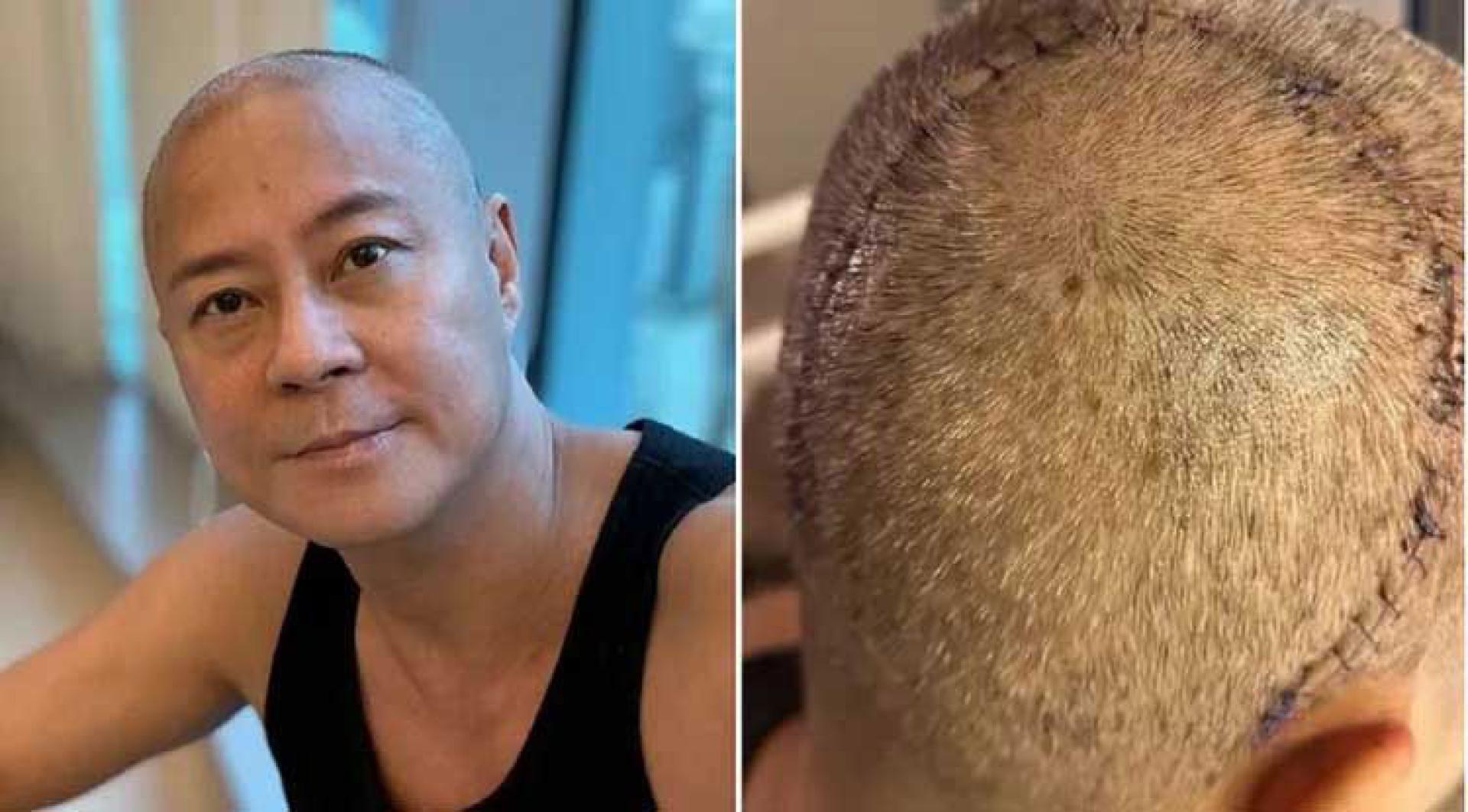 “草蜢”成员蔡一杰因长脑瘤动手术，后脑杓留下巨大的倒U型缝合痕迹。