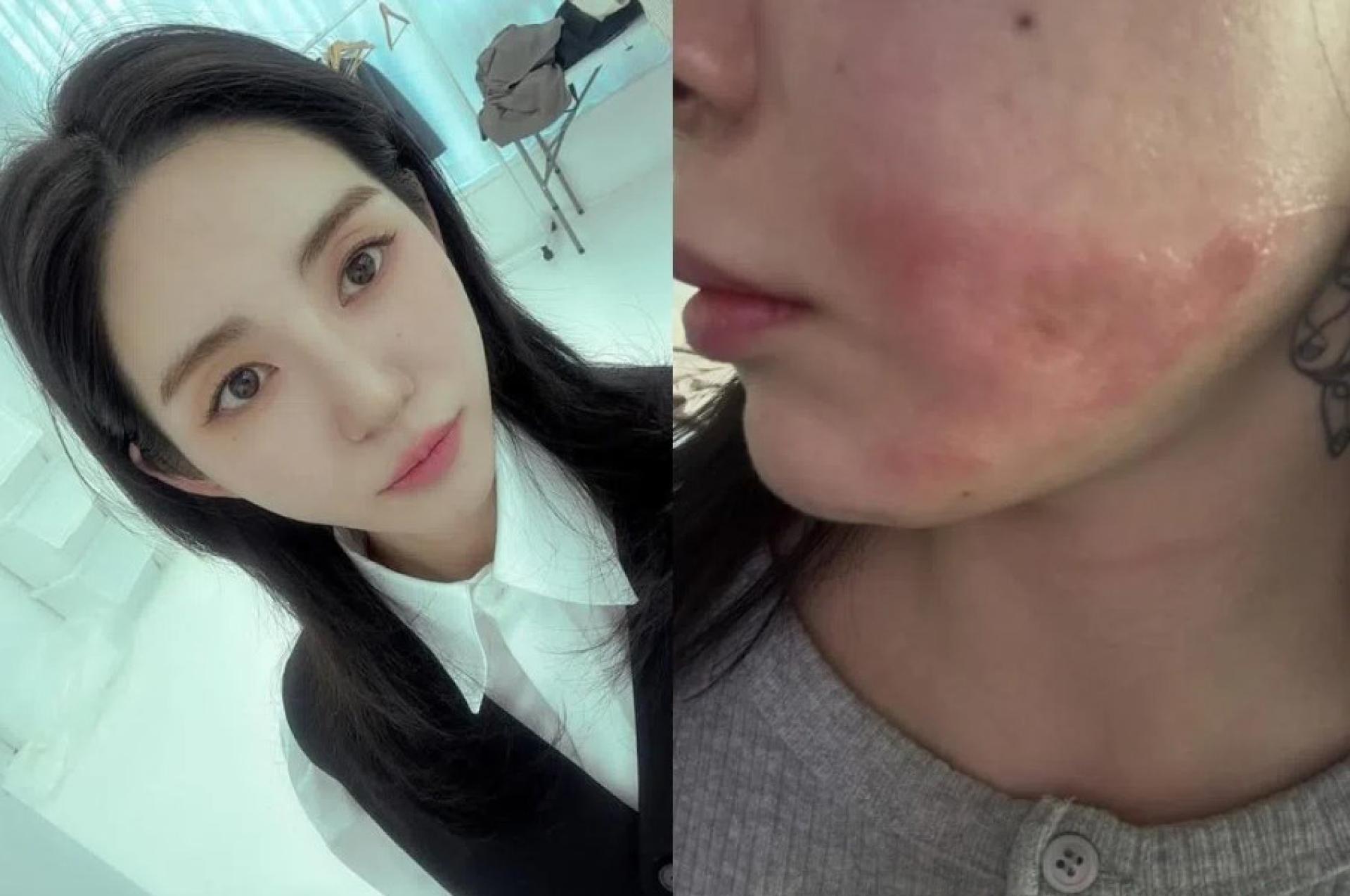 权珉娥在接受医美疗程后脸部二度烧伤（右图）。