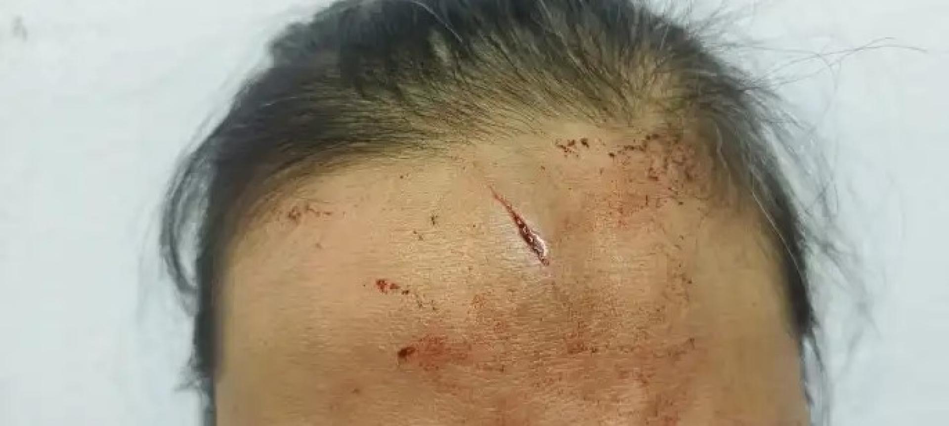 受害者额头受伤特写，显示其在砂拉卓家庭冲突中疑遭瓷砖击中所致伤势。