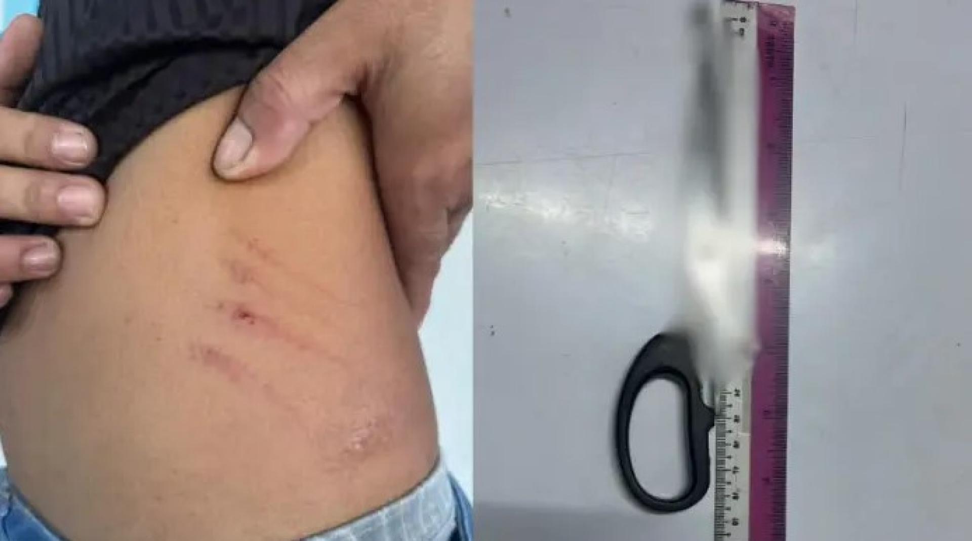 受害者腰部左侧遭攻击后留下的伤痕，以及相信涉案使用的剪刀。（照片来源：砂拉卓警区总部）