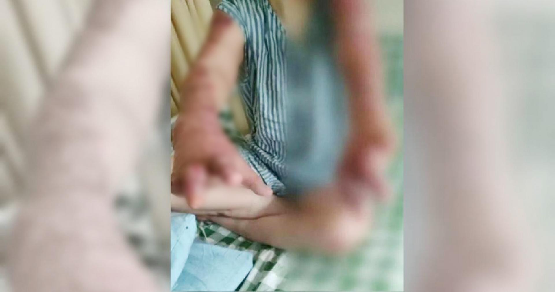 女子忍着剧痛逃离火场，但双手、躯干及四肢均遭严重烧伤，双手10根手指几乎无一完好，脸部也严重受创。