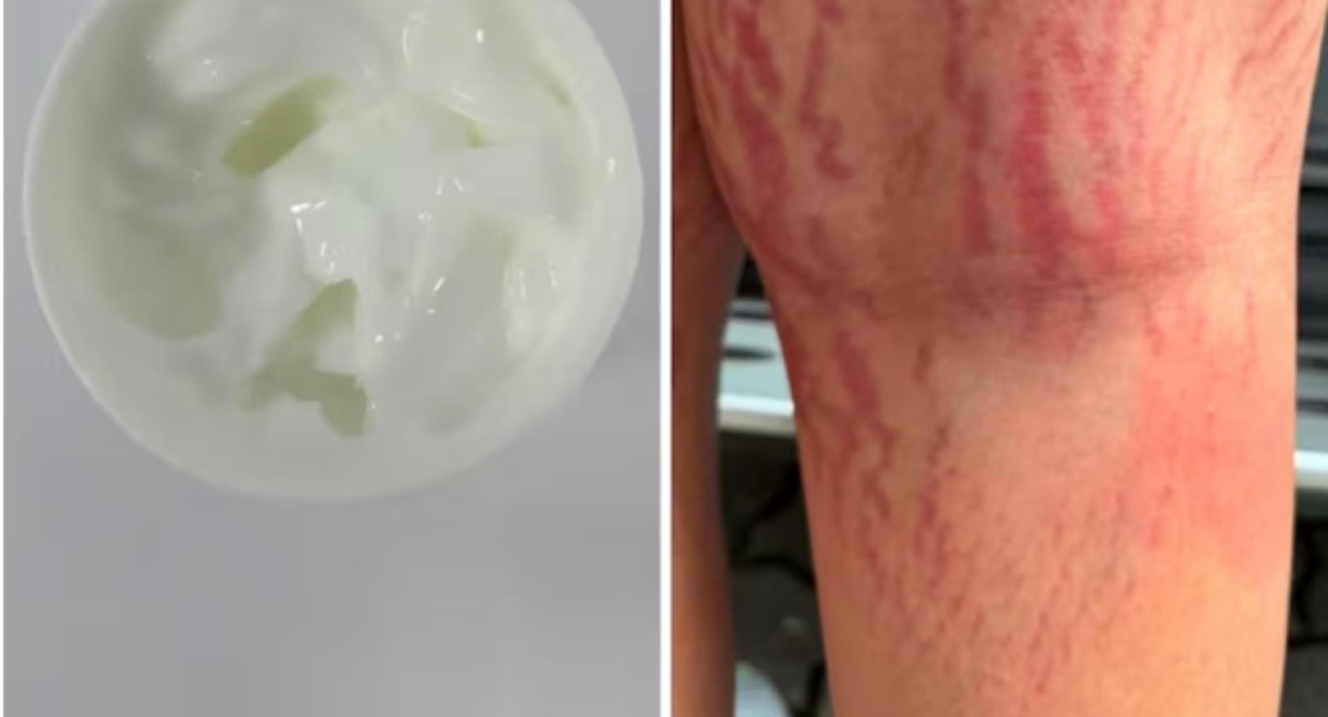一款宣称“不含类固醇”的草本药膏，被揭暗藏强效类固醇成分，导致新加坡一名12岁男童连续使用两个月后，体重暴增6公斤，双腿更出现妊娠纹。（图：新加坡卫生科学局）