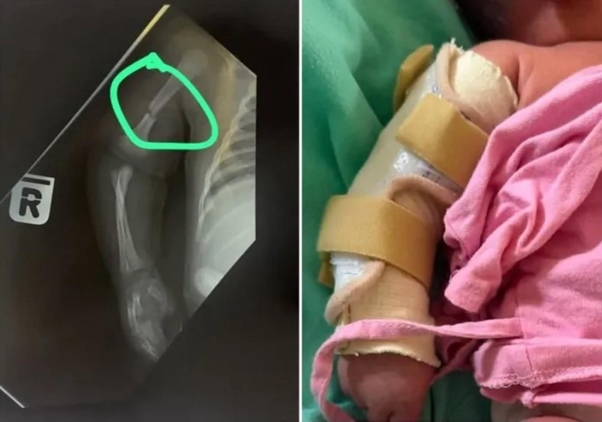 显示婴儿手臂骨折情况的照片，以及相关X光检查影像。