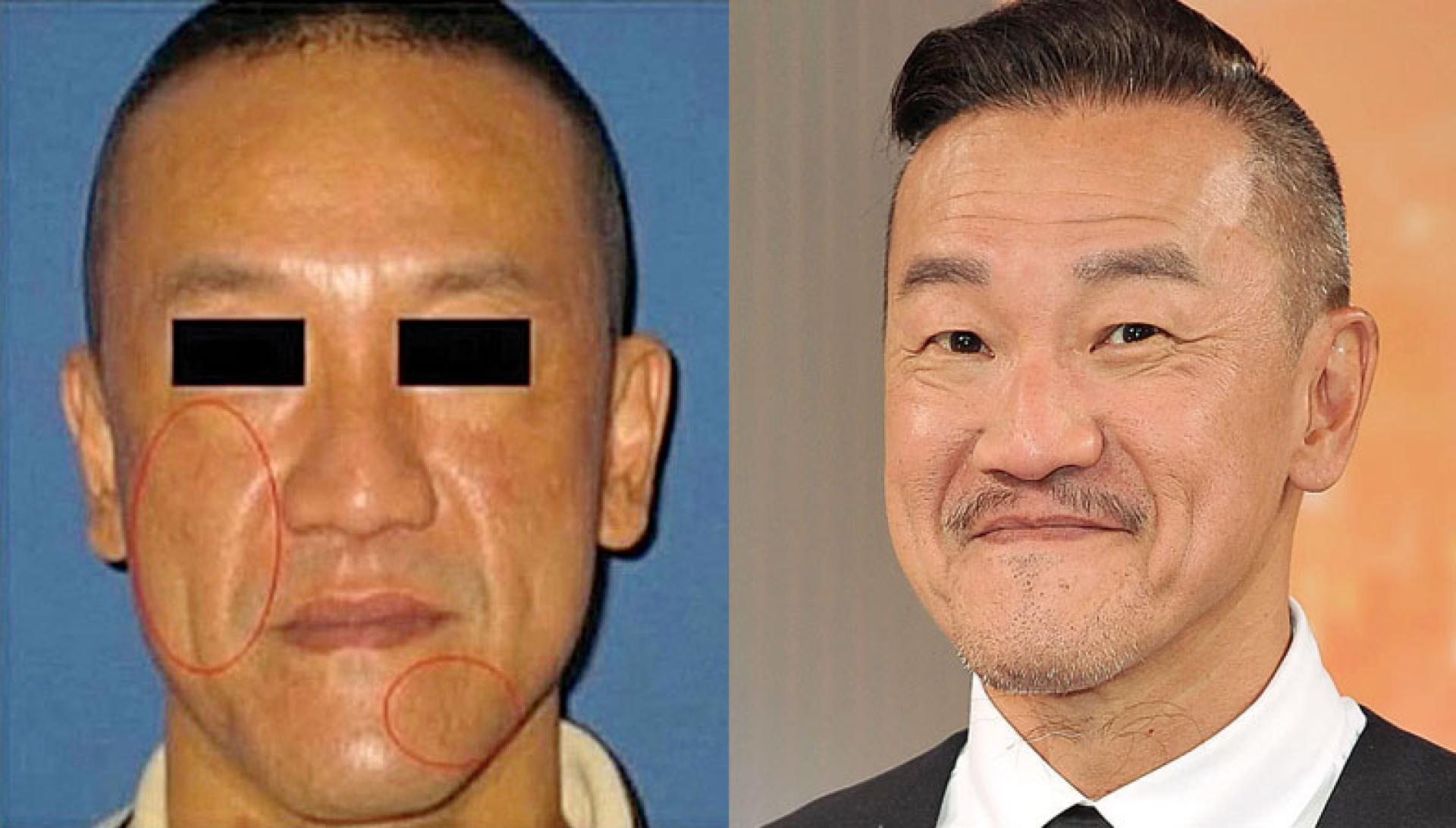 陈为民过去医美案例照被网友翻出，虽然眼睛打上马赛克，仍被大批网友一眼认出。